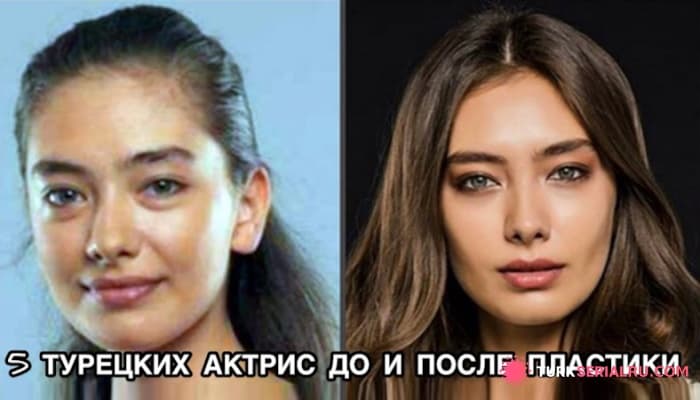 сериал 5 Турецких Актрис До И После Пластики